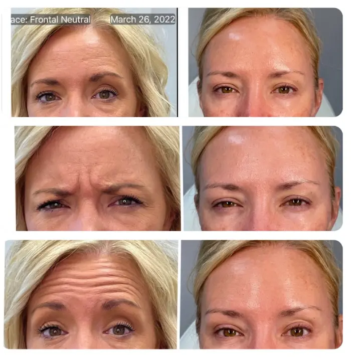 RenuYou-MedSpa-Wellness-botox-ba-a-in-Ankeny-IA