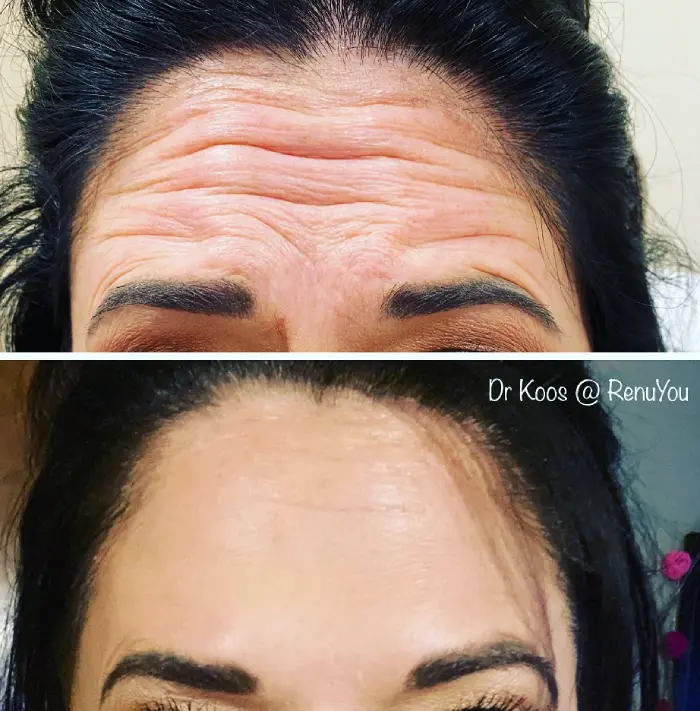 RenuYou-MedSpa-Wellness-botox-ba-b-in-Ankeny-IA