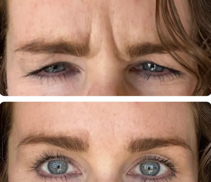 RenuYou-MedSpa-Wellness-botox-ba-c-in-Ankeny-IA