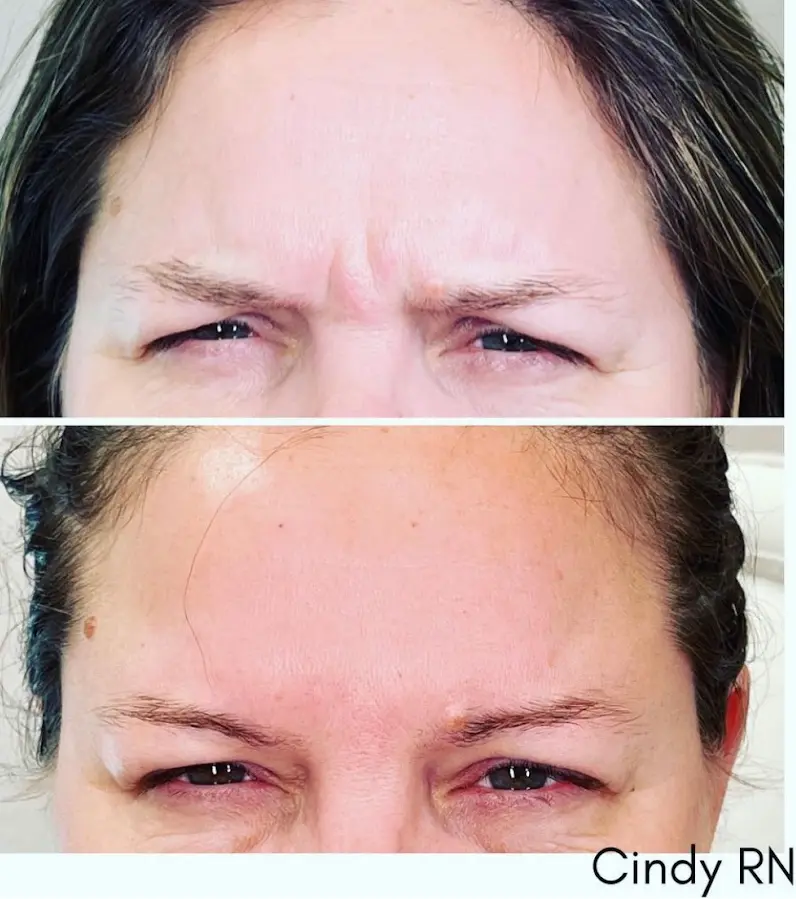 RenuYou-MedSpa-Wellness-botox-ba-d-in-Ankeny-IA