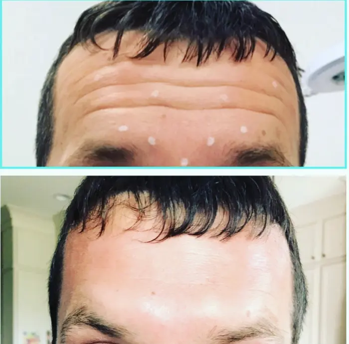 RenuYou-MedSpa-Wellness-botox-ba-e-in-Ankeny-IA