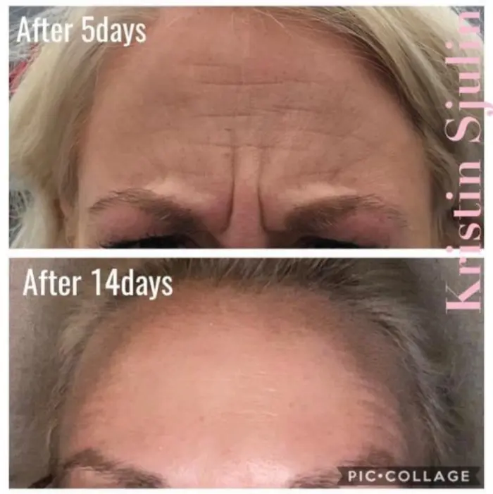 RenuYou-MedSpa-Wellness-botox-ba-f-in-Ankeny-IA