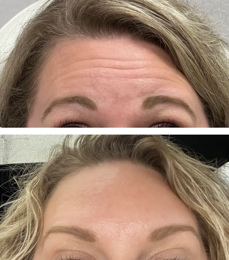 RenuYou-MedSpa-Wellness-botox-ba-g-in-Ankeny-IA