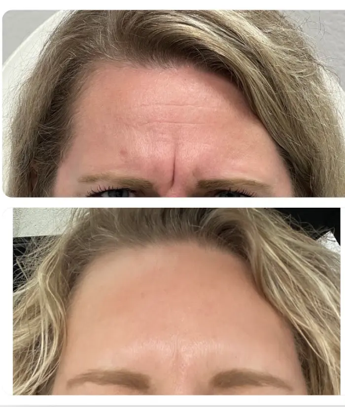 RenuYou-MedSpa-Wellness-botox-ba-h-in-Ankeny-IA