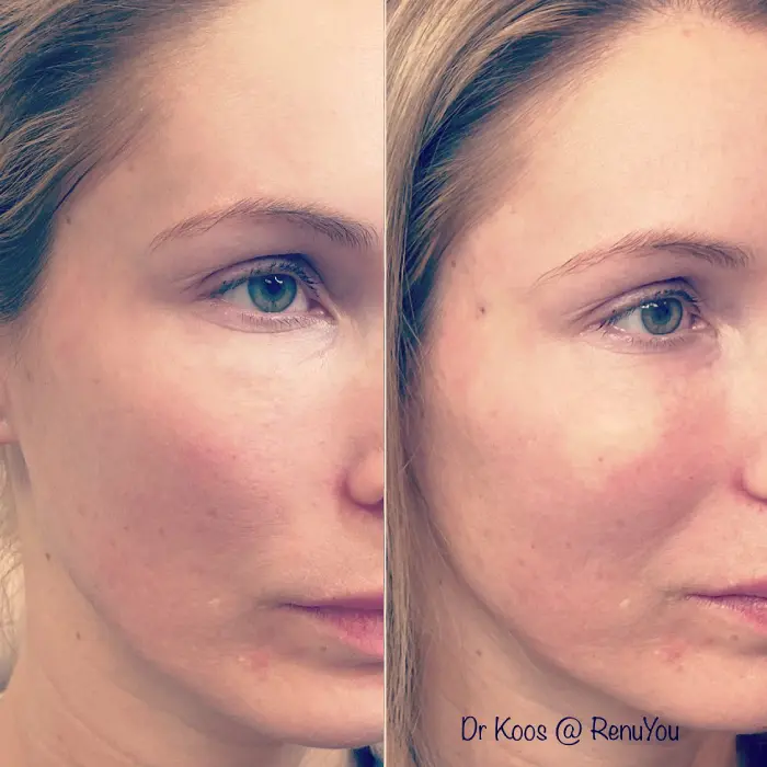 RenuYou-MedSpa-Wellness-cheek-filler-ba-a-in-Ankeny-IA