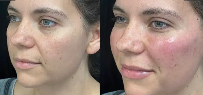 RenuYou-MedSpa-Wellness-cheek-filler-ba-b-in-Ankeny-IA