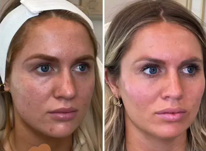 RenuYou-MedSpa-Wellness-cheek-filler-ba-c-in-Ankeny-IA
