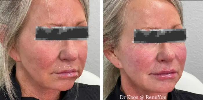 RenuYou-MedSpa-Wellness-cheek-filler-ba-d-in-Ankeny-IA