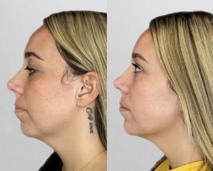 RenuYou-MedSpa-Wellness-full-face-filler-ba-a-in-Ankeny-IA