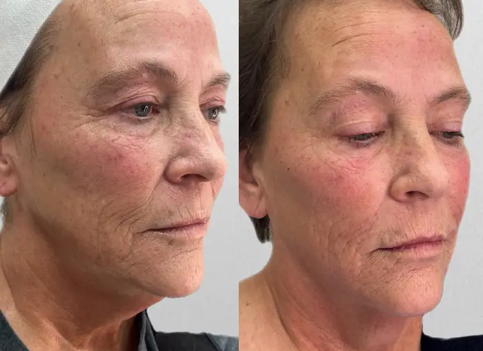RenuYou-MedSpa-Wellness-full-face-filler-ba-b-in-Ankeny-IA