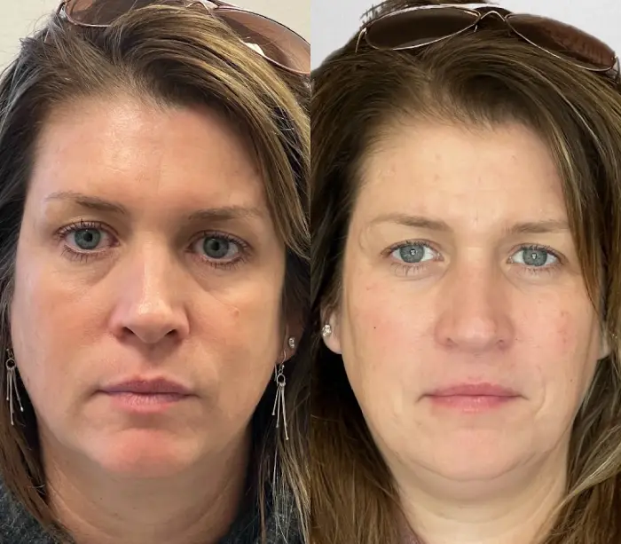RenuYou-MedSpa-Wellness-full-face-filler-ba-c-in-Ankeny-IA