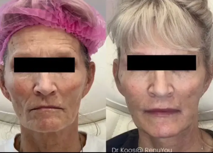 RenuYou-MedSpa-Wellness-full-face-filler-ba-d-in-Ankeny-IA