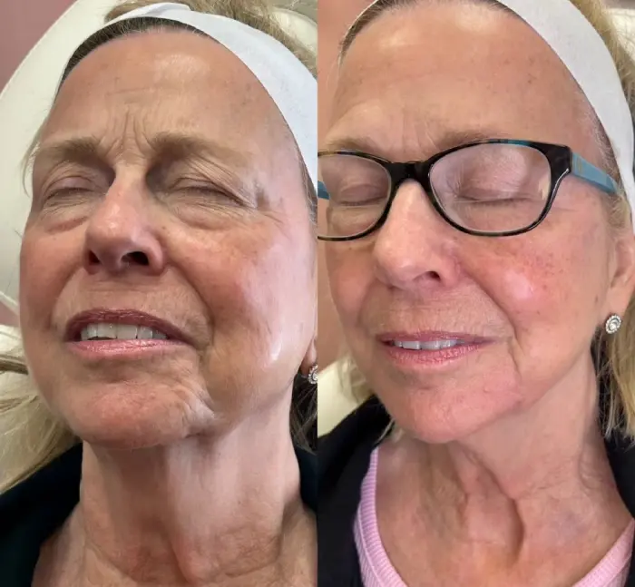 RenuYou-MedSpa-Wellness-full-face-filler-ba-e-in-Ankeny-IA