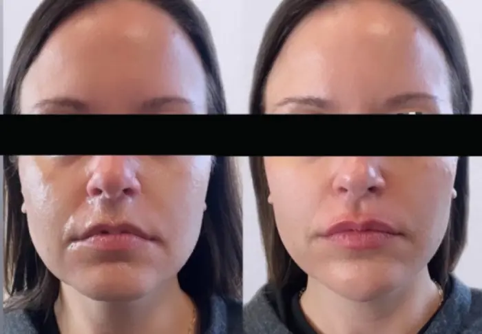 RenuYou-MedSpa-Wellness-full-face-filler-ba-f-in-Ankeny-IA