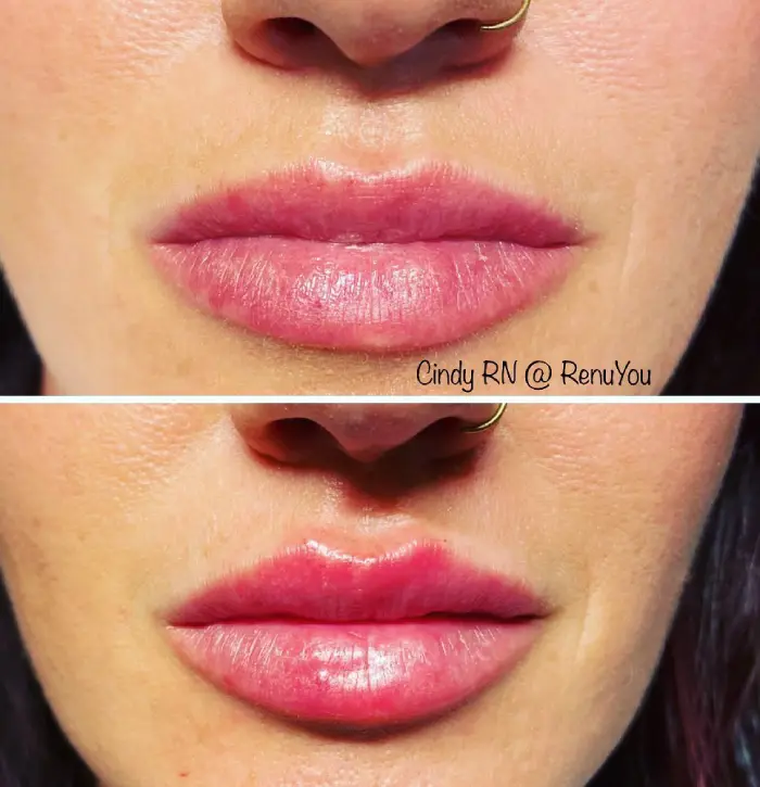 RenuYou-MedSpa-Wellness-lip-filler-ba-a-in-Ankeny-IA