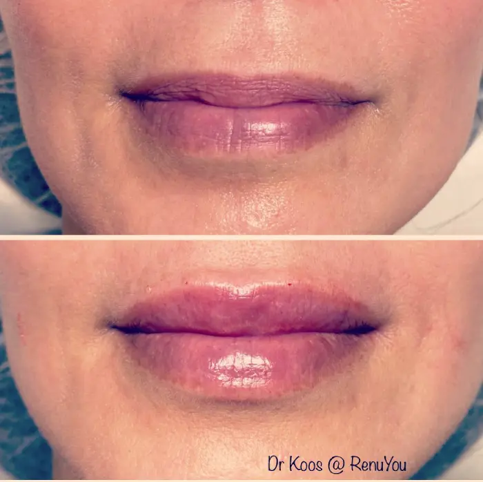 RenuYou-MedSpa-Wellness-lip-filler-ba-b-in-Ankeny-IA