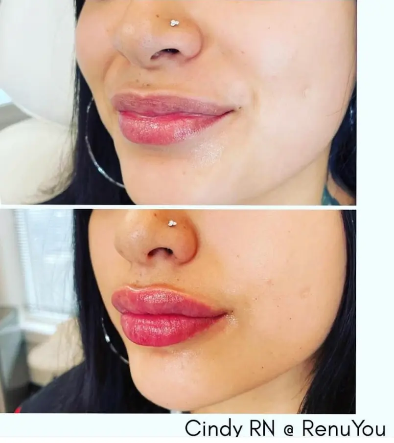 RenuYou-MedSpa-Wellness-lip-filler-ba-c-in-Ankeny-IA