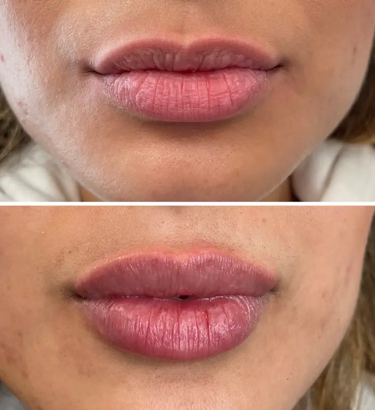 RenuYou-MedSpa-Wellness-lip-filler-ba-d-in-Ankeny-IA