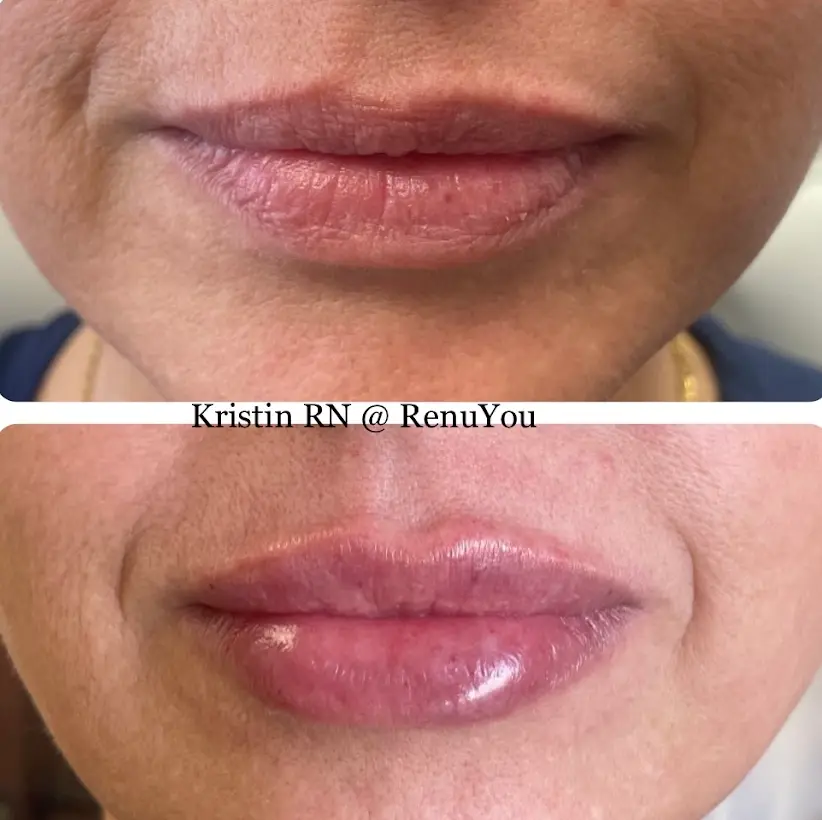 RenuYou-MedSpa-Wellness-lip-filler-ba-e-in-Ankeny-IA