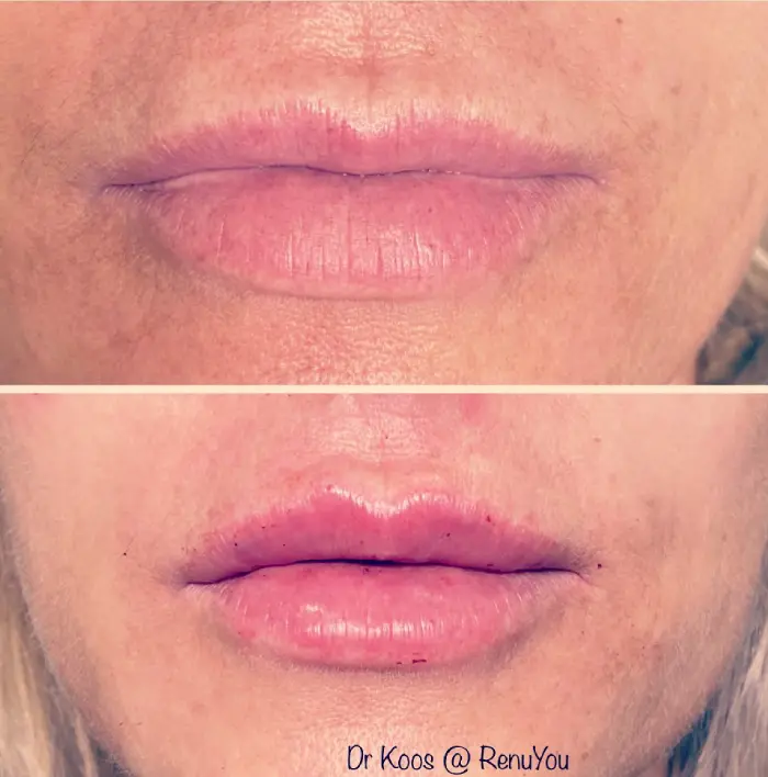 RenuYou-MedSpa-Wellness-lip-filler-ba-f-in-Ankeny-IA