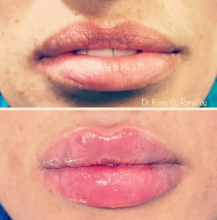 RenuYou-MedSpa-Wellness-lip-filler-ba-g-in-Ankeny-IA