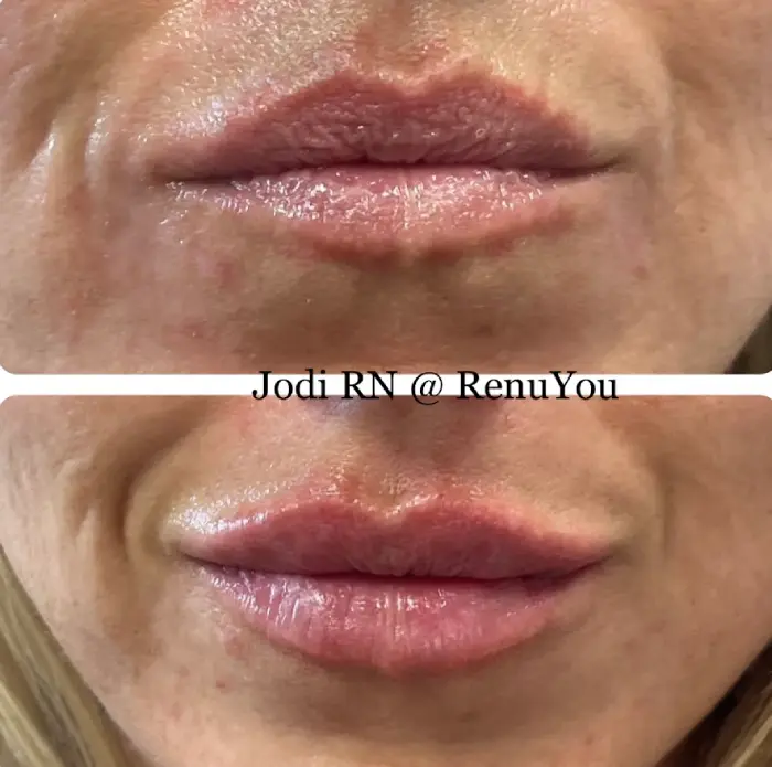 RenuYou-MedSpa-Wellness-lip-filler-ba-h-in-Ankeny-IA