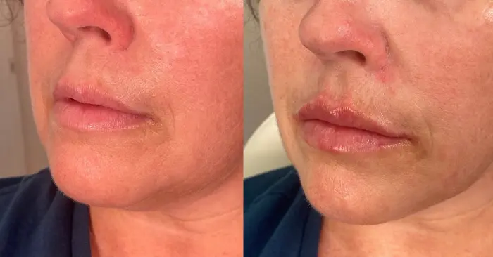 RenuYou-MedSpa-Wellness-lip-filler-ba-i-in-Ankeny-IA