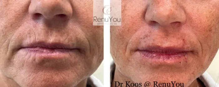 RenuYou-MedSpa-Wellness-lip-filler-ba-j-in-Ankeny-IA