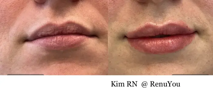 RenuYou-MedSpa-Wellness-lip-filler-ba-k-in-Ankeny-IA