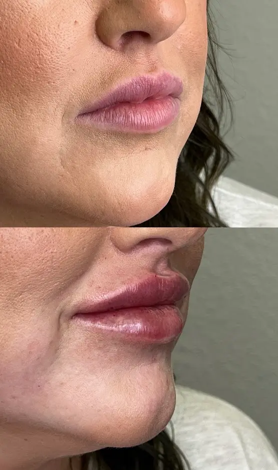 RenuYou-MedSpa-Wellness-lip-filler-ba-l-in-Ankeny-IA
