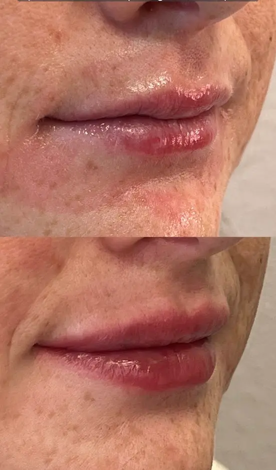 RenuYou-MedSpa-Wellness-lip-filler-ba-m-in-Ankeny-IA