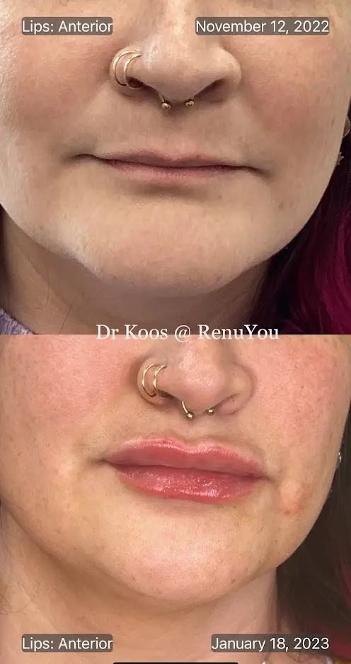 RenuYou-MedSpa-Wellness-lip-filler-ba-n-in-Ankeny-IA