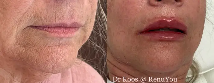 RenuYou-MedSpa-Wellness-lip-filler-ba-o-in-Ankeny-IA
