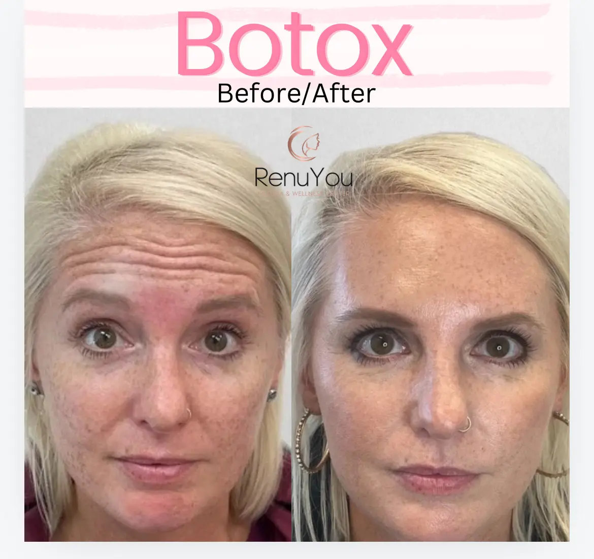 botox-ba-b-in-ames-ia