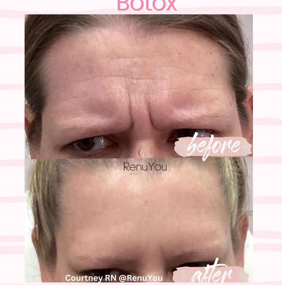 botox-ba-c-in-ames-ia