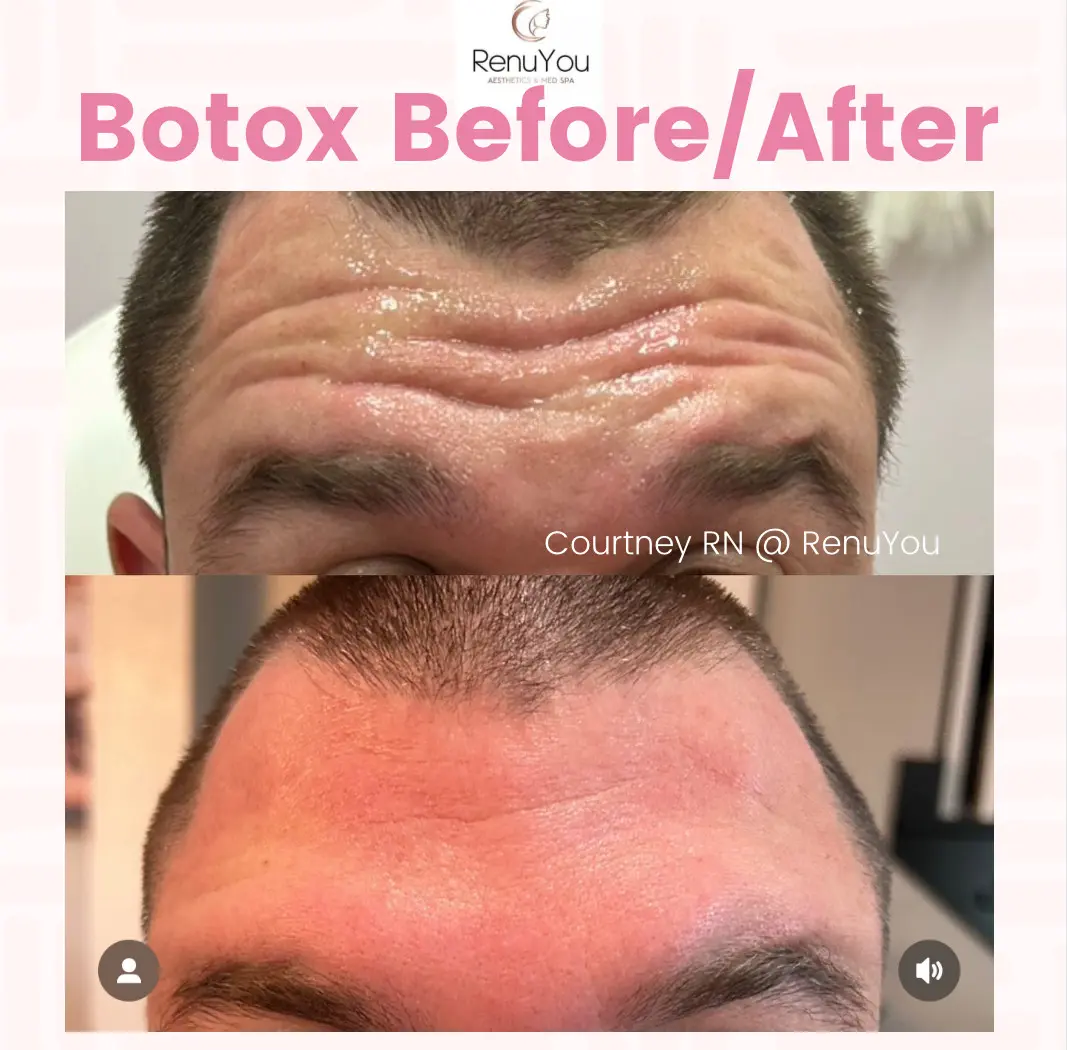botox-ba-d-in-ames-ia