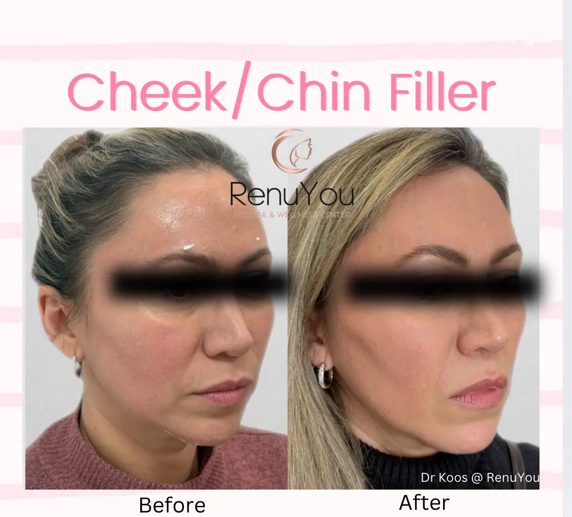 cheek-chin-filler-ba-a-in-ames-ia