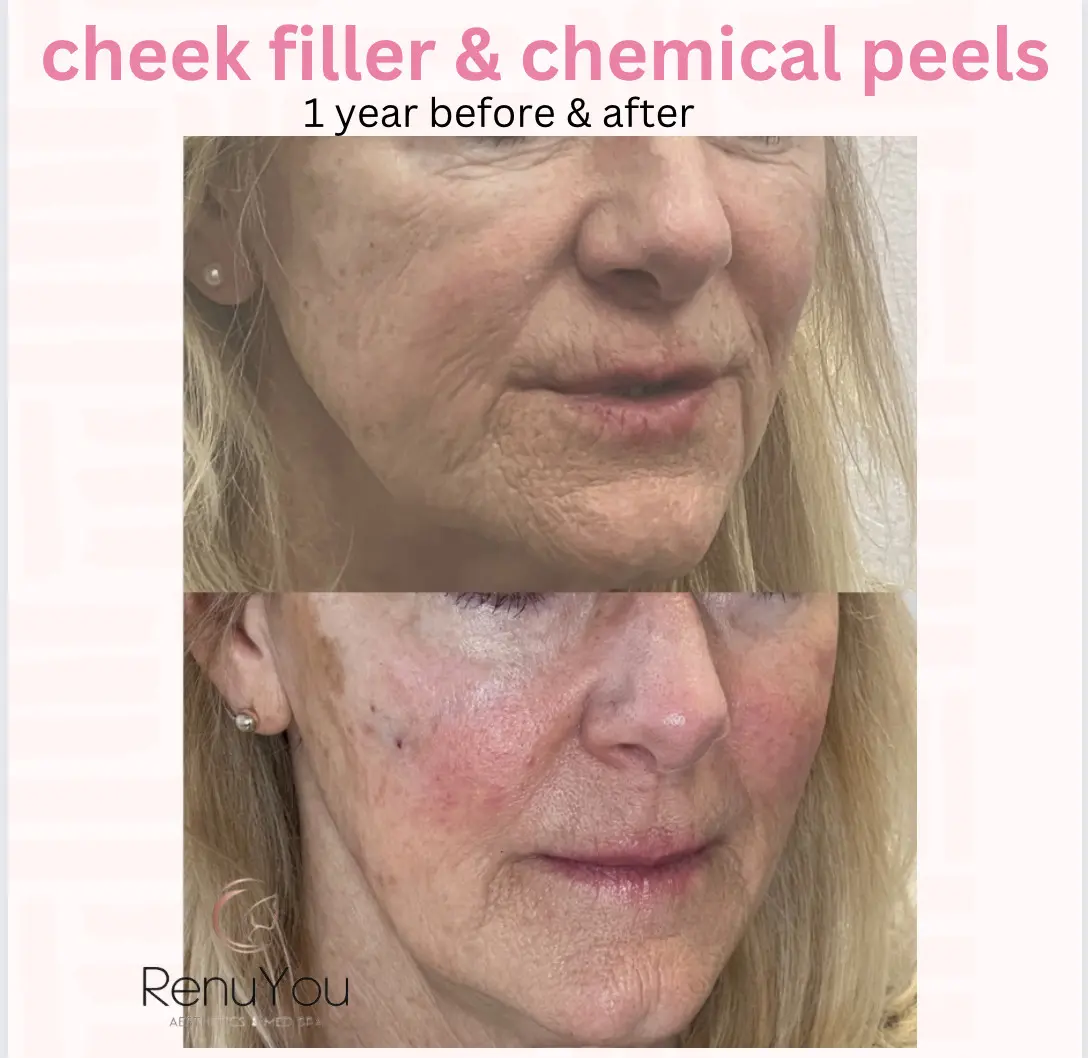 chemical-peel-ba-a-in-ames-ia