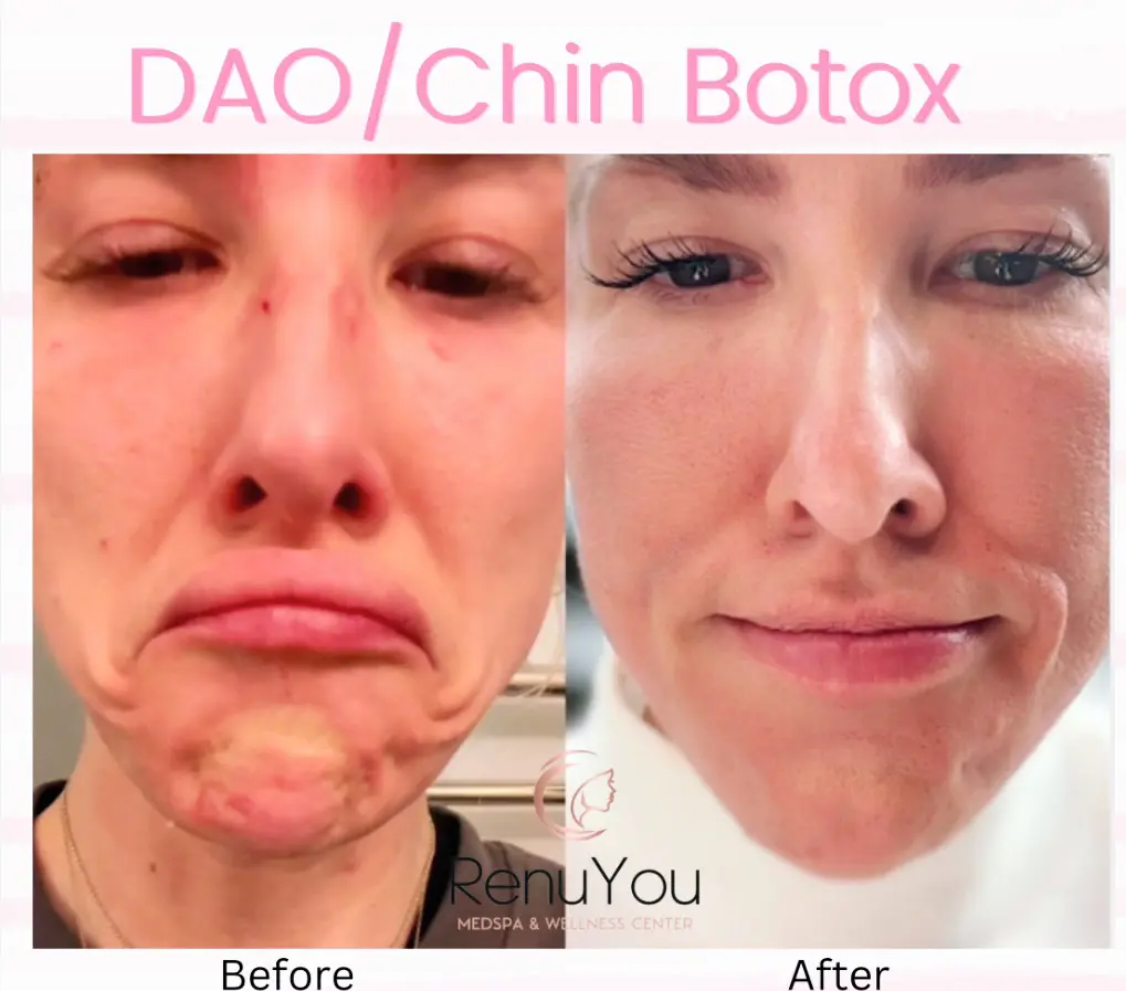 chin-botox-ba-a-in-ames-ia