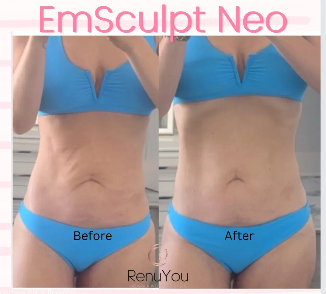 emsculpt-ba-a-in-ames-ia