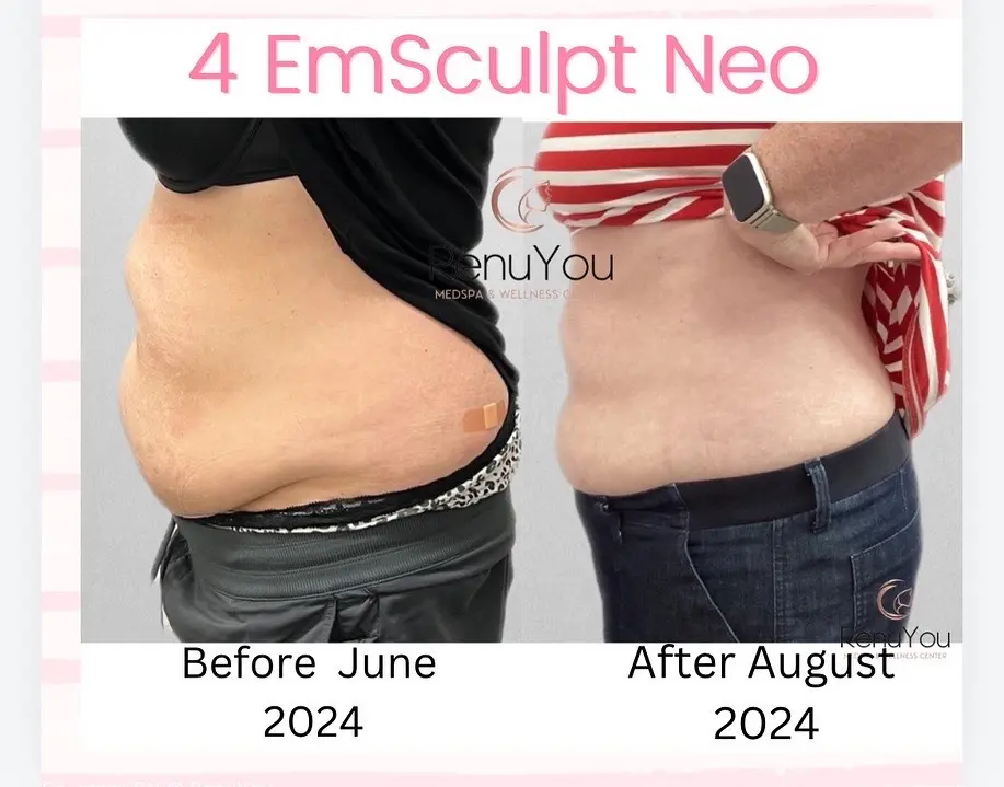emsculpt-ba-b-in-ames-ia