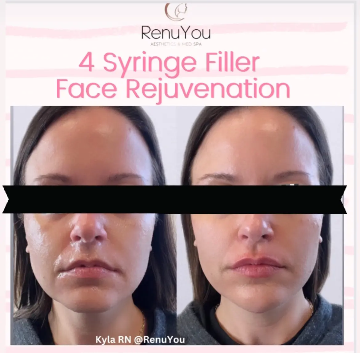 face-rejuvenation-ba-a-in-ames-ia