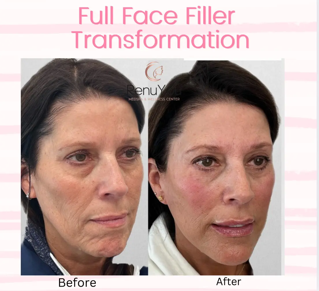 full-face-filler-ba-a-in-ames-ia
