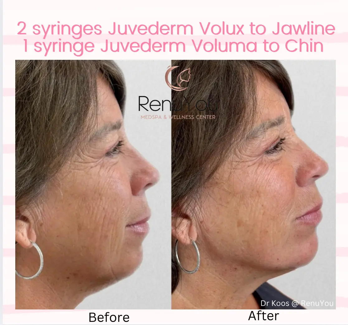 juvederm-ba-a-in-ames-ia