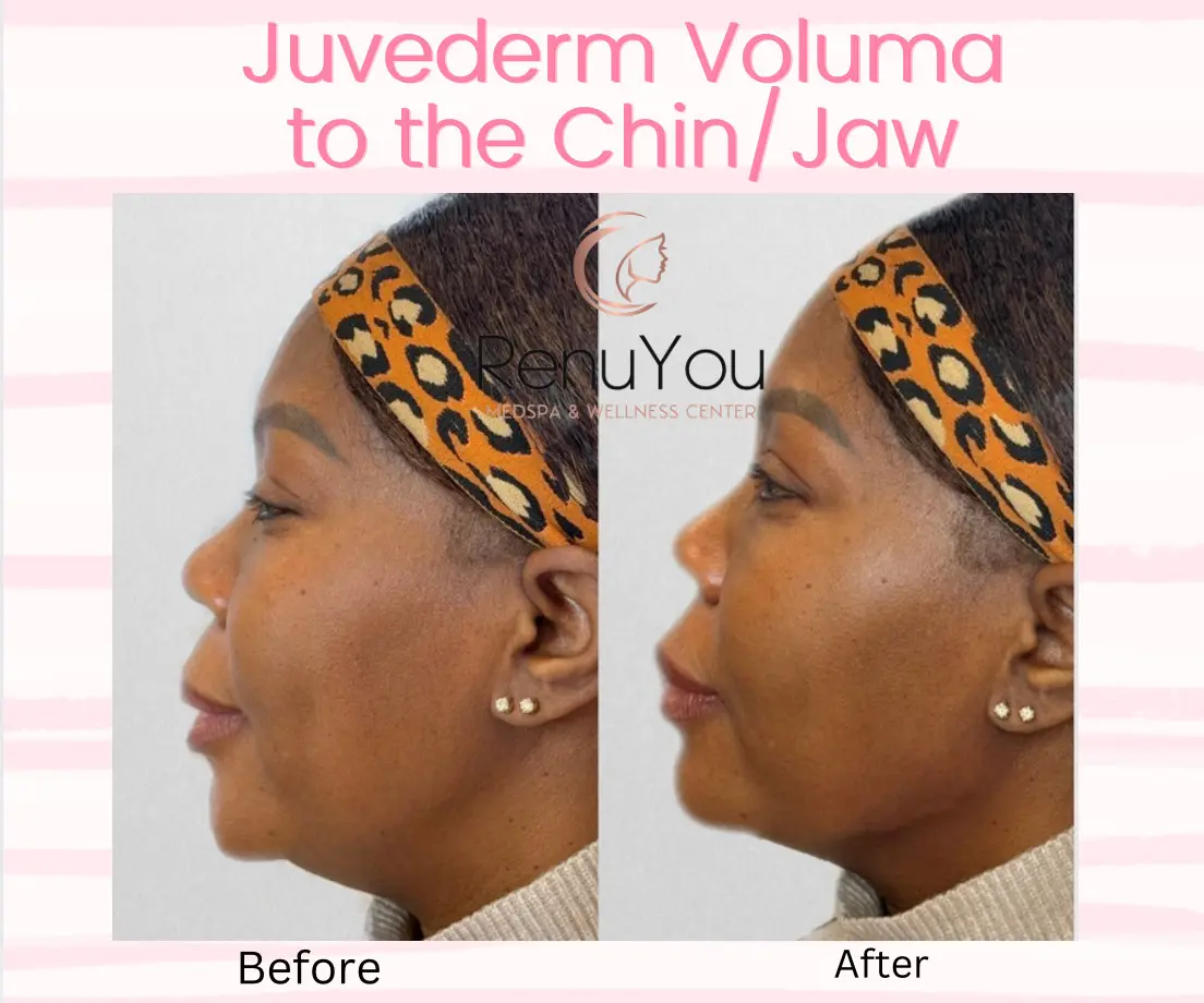juvederm-voluma-ba-a-in-ankeny-ia