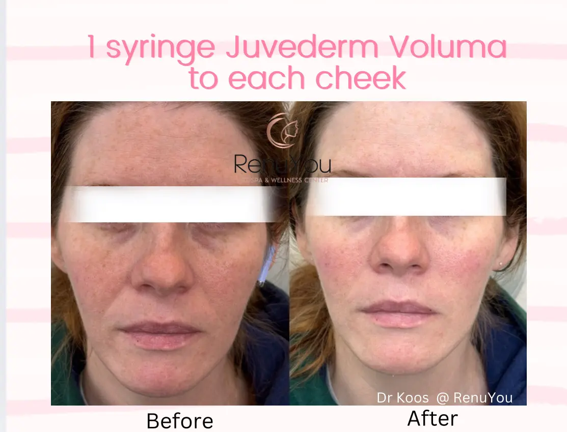 juvederm-voluma-ba-b-in-ames-ia