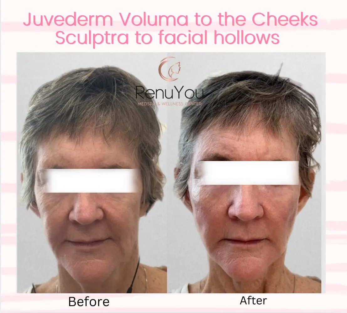 juvederm-voluma-ba-d-in-ames-ia