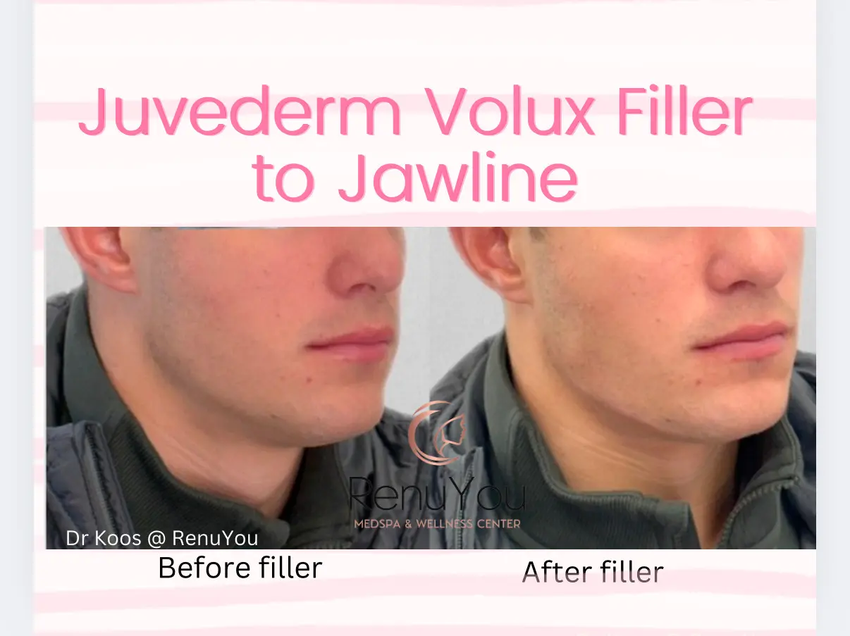 juvederm-volux-ba-a-in-ames-ia