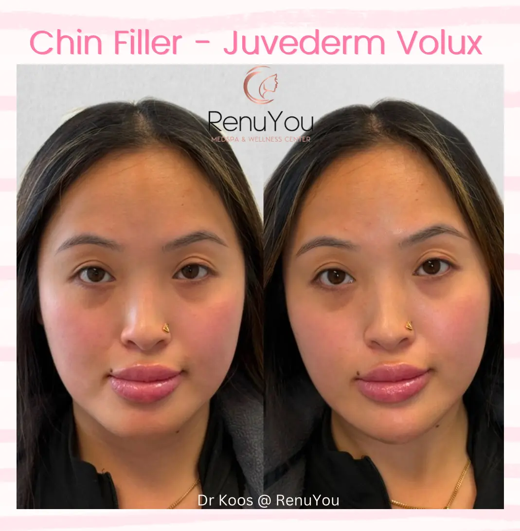 juvederm-volux-ba-d-in-ames-ia