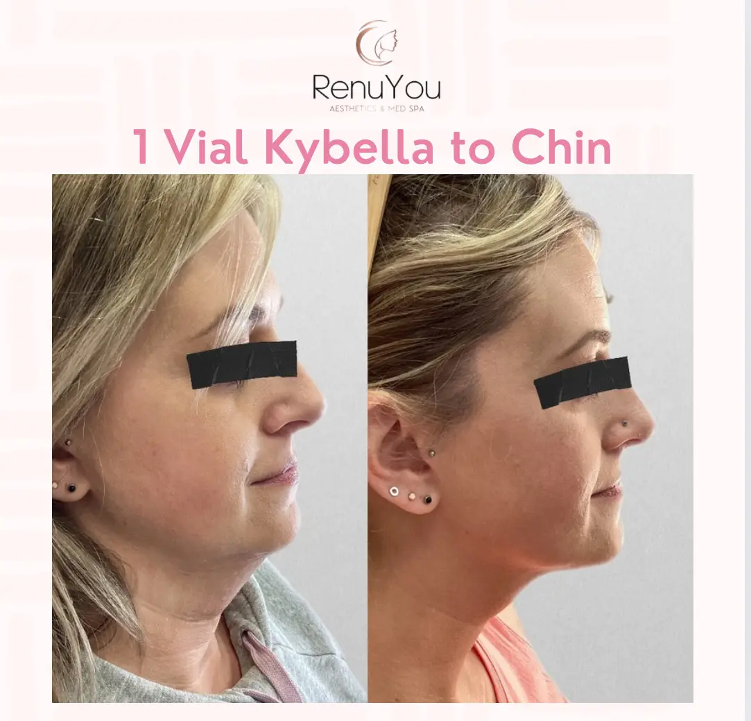 kybella-ba-a-in-ames-ia